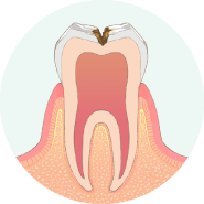 虫歯が神経に近くなり、冷たいものがしみます
