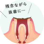 神経が死んでしまい、痛みを感じなくなります