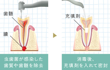 虫歯菌が感染した歯質や歯髄を除去（歯髄・膿）消毒後、充填剤を入れて密封（充填剤）