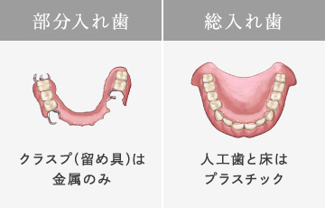 部分入れ歯…クラスプ（留め具）は金属のみ　総入れ歯…人工歯と床はプラスチック