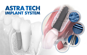 ASTRA TECH IMPLANT SYSTEM