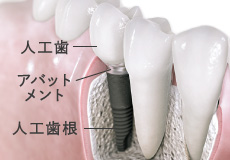 人工歯・アバットメント・人工歯根